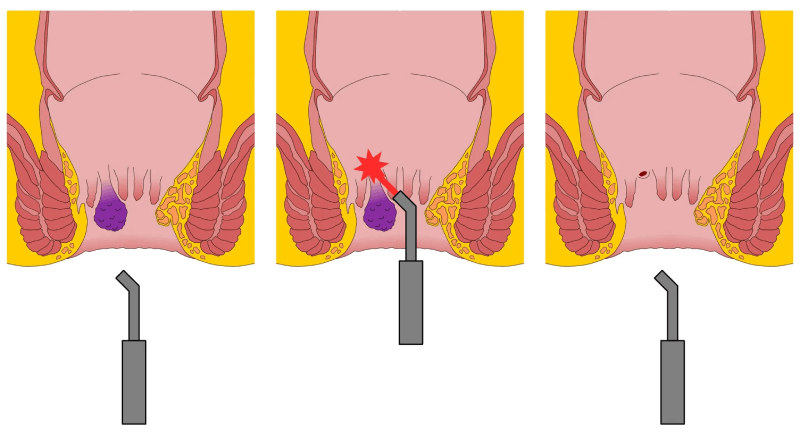 Liečba hemoroidov laserovou operáciou LHC Leonardo
