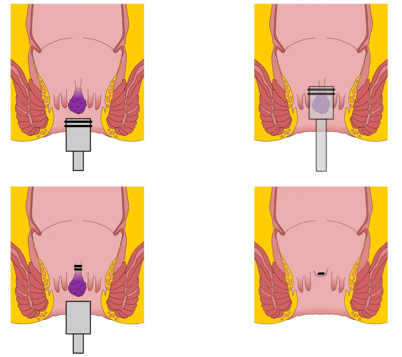 Liečba hemoroidov Baronovou gumičkovou ligatúrou