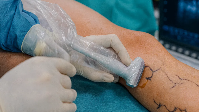 Operácia kŕčových žíl so zľavou 30 % pre poistencov Union – odborná starostlivosť a krásne nohy bez bolesti